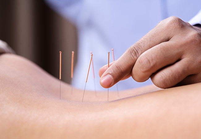 acupuncture-services-active-spine-and-sports-care-ventura-camarillo1