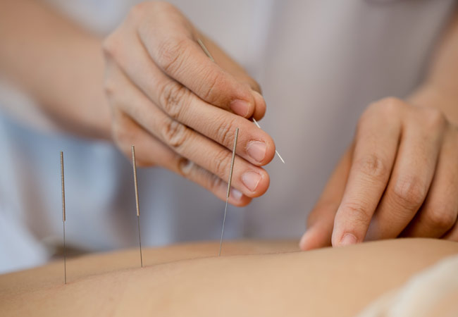 acupuncture-services-active-spine-and-sports-care-ventura-camarillo2